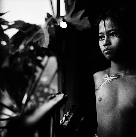 © Paolo Pellegrin/Magnum Photos/Contrasto. Mädchen, das seinen Arm bei der Arbeit in einer Ziegelfabrik verlor. Phnom Penn 1998